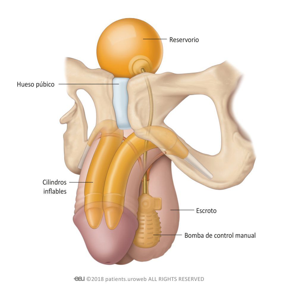 Fig. 1: A common type of inflatable penile implant.